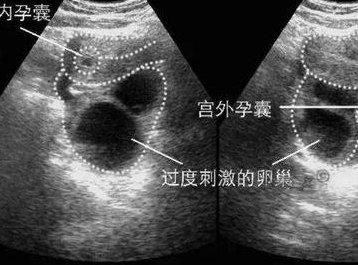 第三代试管婴儿可以的试管吗？附三代试管条件详情