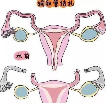 杭州三代试管助孕试管能成功多少钱？试管能成功怎么回事？